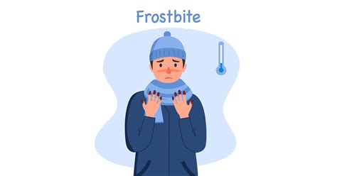 Frostbite: Symptoms, Causes, & First Aid Guide