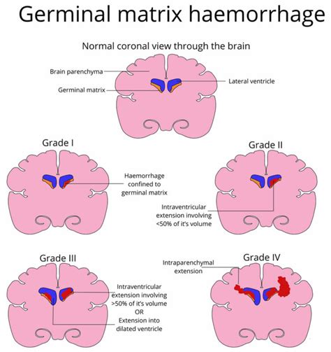 Germinal matrix hemorrhage causes, symptoms, diagnosis, treatment & prognosis