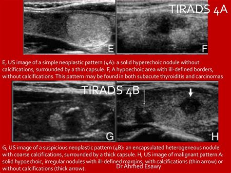 TIRADS (thyroid nodule imaging reporting and data system) Dr Ahmed E…