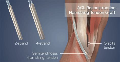 ACL Reconstruction Surgery Complete Guide│Injury To Recovery