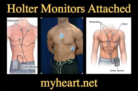 Holter Monitor Explained by a Cardiologist • MyHeart