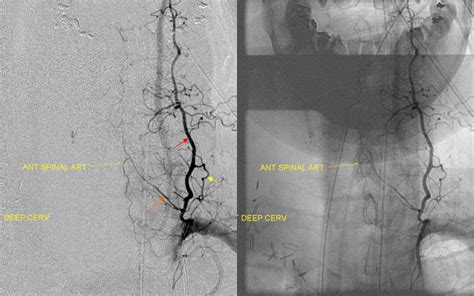 Subclavian Artery | neuroangio.org