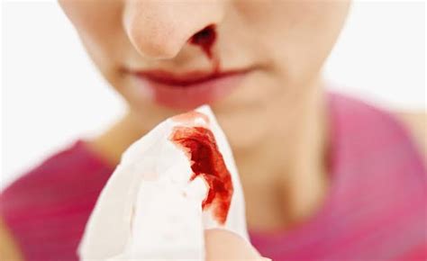 Epistaxis - Symptoms, Causes, Types, Treatment & Prevention - Santripty