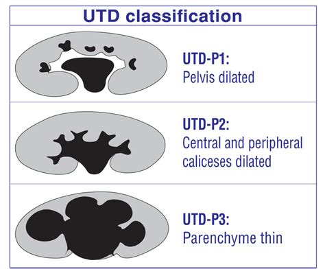 Grading of Hydronephrosis: An Ongoing Challenge | Semantic Scholar