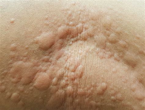 What are hives, the common skin condition that gives you itchy, red bumps?