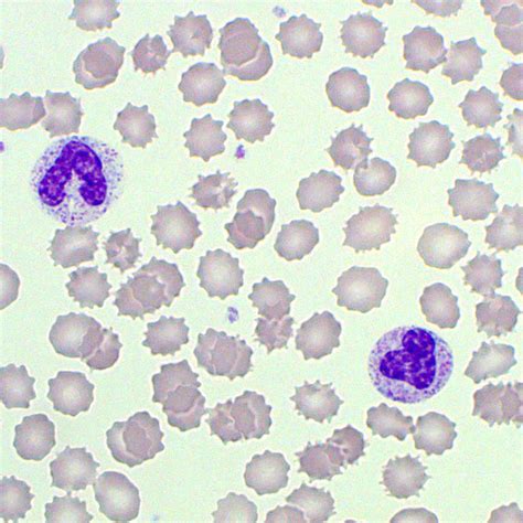 Poikilocytosis | Blood Film - MedSchool