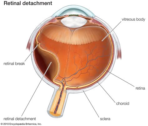 Detached retina | Causes, Symptoms & Treatment | Britannica