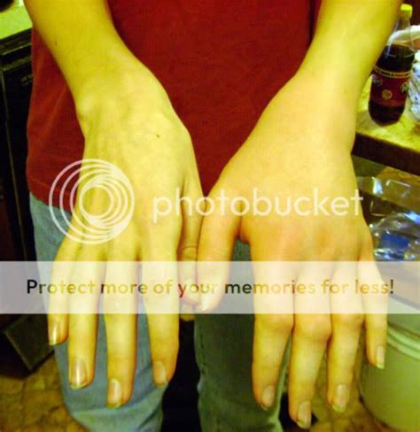 bee sting swelling photos