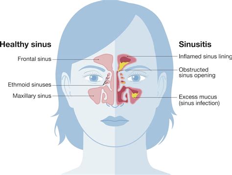 Sinus Infection Symptoms and Treatment Houston TX