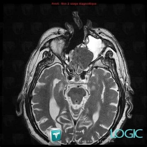 Radiology case : Adenocarcinoma (MRI) - Diagnologic