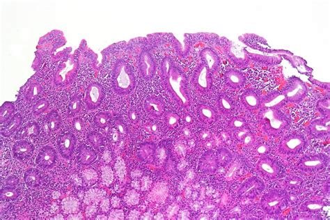 Coeliac Disease | Symptoms, Signs, Management | Geeky Medics