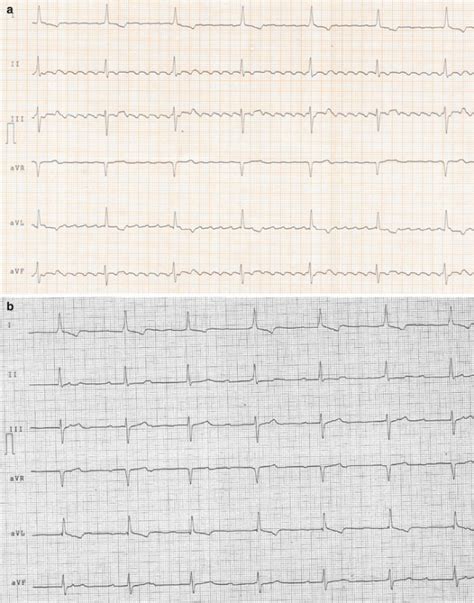 Sinoatrial Exit Block | Thoracic Key