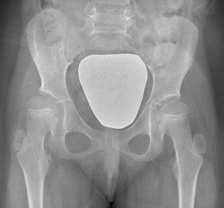 Coxa valga | Radiology Reference Article | Radiopaedia.org