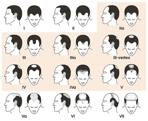 Where Are You on the Norwood Hair Loss Scale? - Vinci Hair Clinic