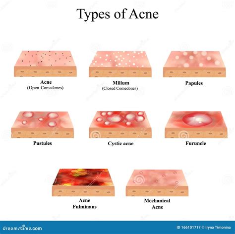 Types of Acne Skin Inflammation. Pimples, Boils, Whitehead, Closed ...