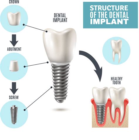 Dental Implants: How They Work & What They Are Made Of | Family ...