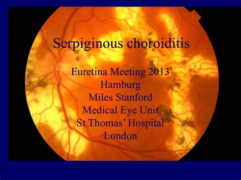 Serpiginous choroiditis