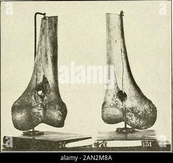 Gunshot Fracture of the Shaft of the Right Femur, United with Great ...