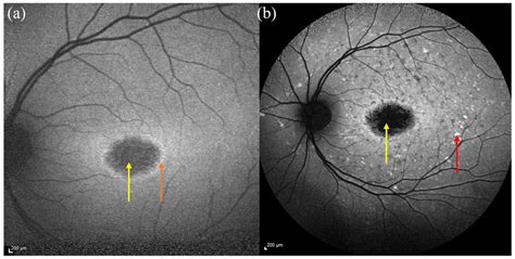 FAF image showing bull’s eye maculopathy (a) baseline imaging showing ↓... | Download Scientific ...