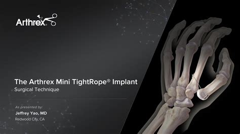 Arthrex - The Arthrex Mini TightRope® Implant