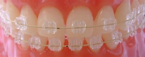 Breket.md – Sapphire braces