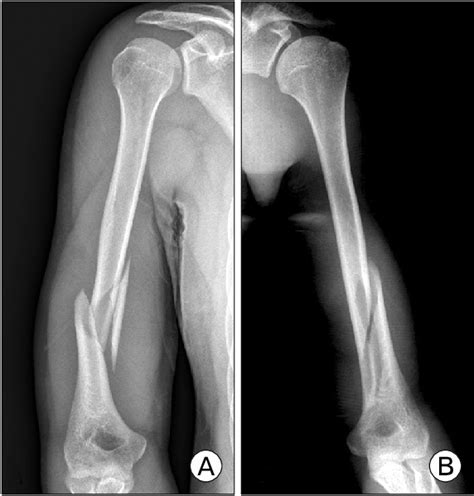 Typical type of fracture caused by arm wrestling is the external ...