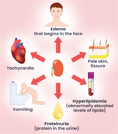 Proteinuria | American Dialysis CenterAmerican Dialysis Center