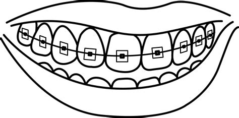 smile with braces clipart 10 free Cliparts | Download images on Clipground 2024