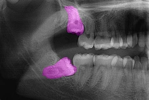 Impacted tooth (tooth impaction) | Studio Dentaire