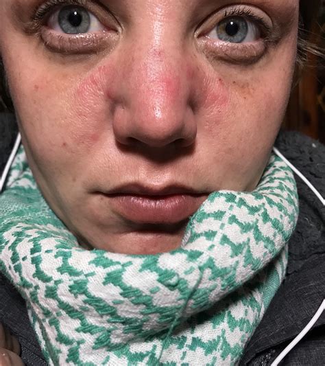 Is this Rosacea?? Dry, cystic type bumps, red, coarse, and sorrow. : r/Rosacea