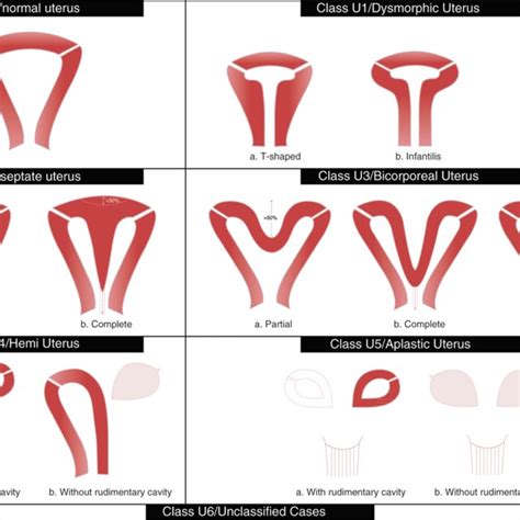 Arcuate uterus in a 17-year-old girl with right-lower-quadrant pain... | Download Scientific Diagram