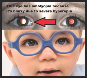 What Is Amblyopia? - The 3 Causes of Amblyopia