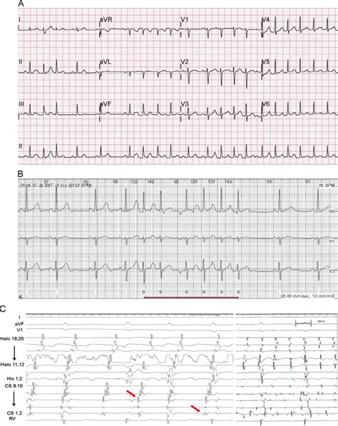 A. ECG showed an irregular narrow QRS complex tachycardia, which... | Download Scientific Diagram