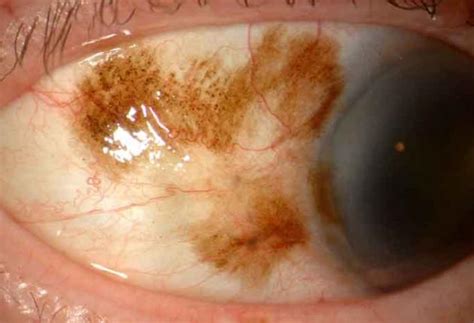 melanosis eye - pictures, photos