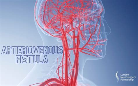 Arteriovenous Fistula - London Neurosurgery Partnership