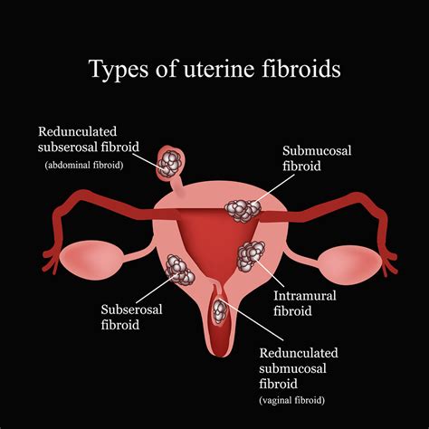 10 Cm Uterine Fibroid