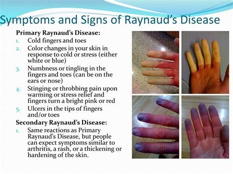 PPT - Raynaud’s Disease or Raynaud’s Phenomenon PowerPoint Presentation ...