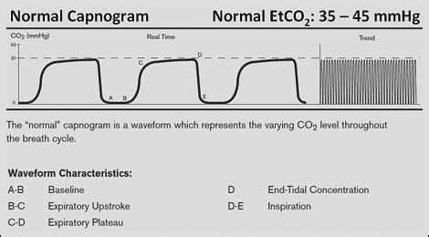 R Series Advanced Monitoring: Capnography Waveforms - ZOLL Medical