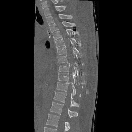 T7/8 fracture-dislocation | Radiology Case | Radiopaedia.org