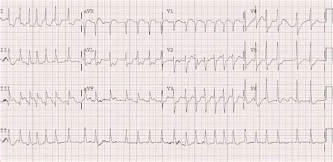 Dr. Smith's ECG Blog: Atrial Fibrillation with RVR and Inferoposterior ST elevation (Injury Pattern)