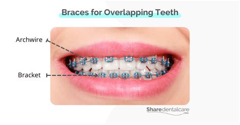 Veneers for Overlapping Teeth: Benefits & Procedure - Share Dental Care