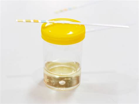 Urine Urea Nitrogen Test: Purpose, Procedure, and Results