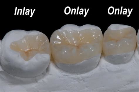 Crowns, Inlays & Onlays - D.R. Dental Clinics