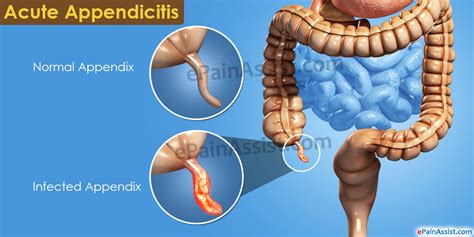 Acute Appendicitis|Causes|Signs|Symptoms|Treatment