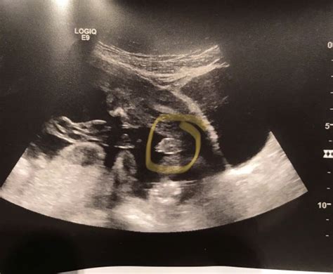 20 Week Anatomy Scan | BabyCenter