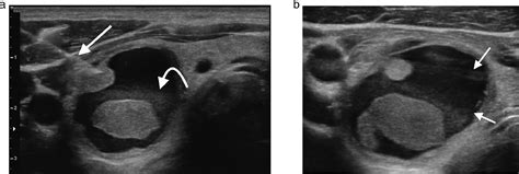 Ultrasound Guided Thyroid Biopsy - Techniques in Vascular ...