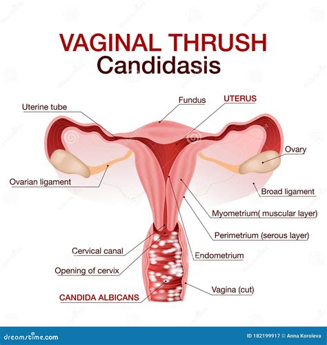 Vaginal Infection, Venereal Disease Concept. Ginecological Disorder ...