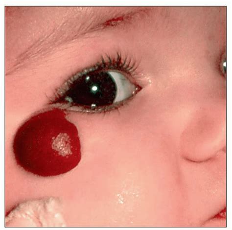 Infantile (Juvenile) Hemangioma | Basicmedical Key