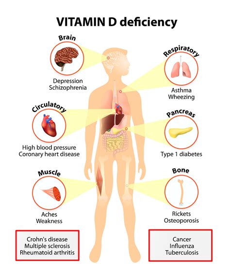 Vitamin D Deficiency Signs And Symptoms Nhs