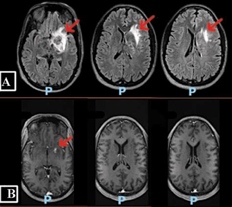 Cureus | Listerial Meningitis and Brain Abscess With Coexisting COVID-19 Infection in a Young ...